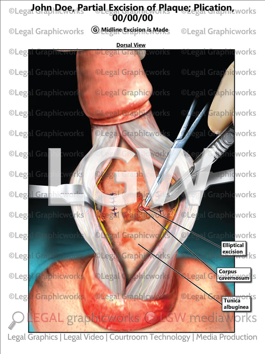 Partial Excision of Plaque; Plication
