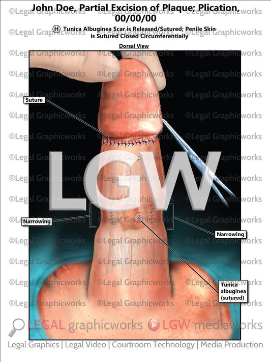 Partial Excision of Plaque; Plication