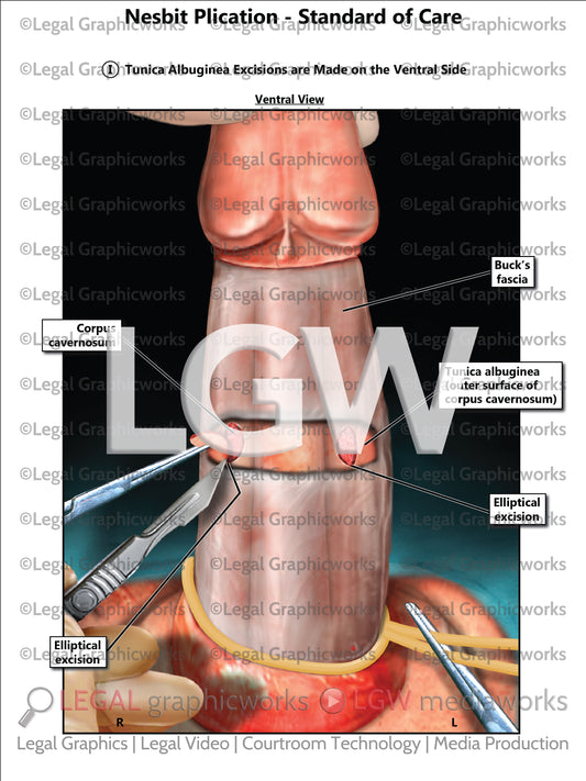 Nesbit Plication - Standard of Care