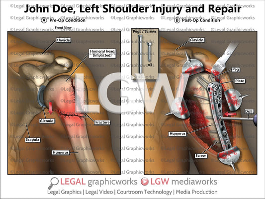Left Shoulder Injury and Repair