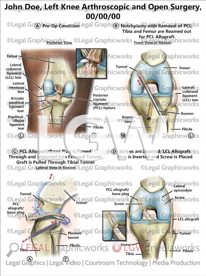 Left Knee Arthroscopic and Open Surgery