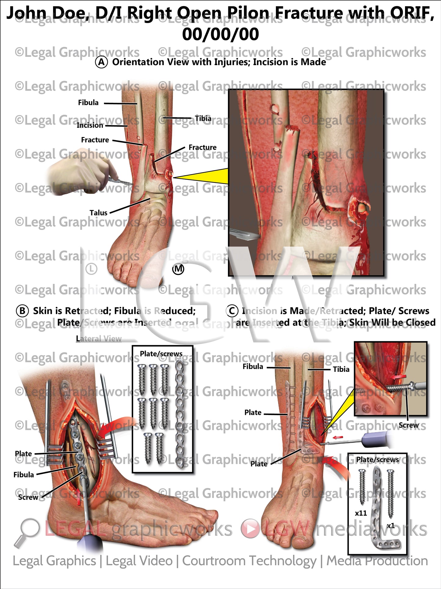 D/I Right Open Pilon Fracture with ORIF