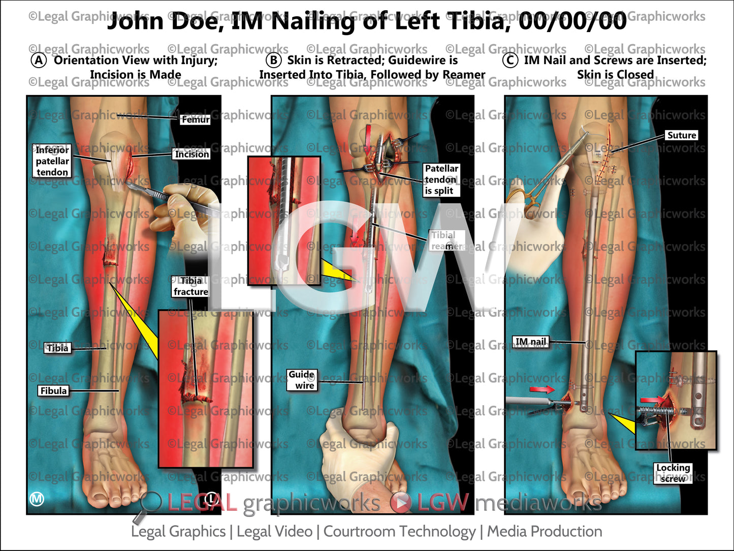 IM Nailing of Left Tibia