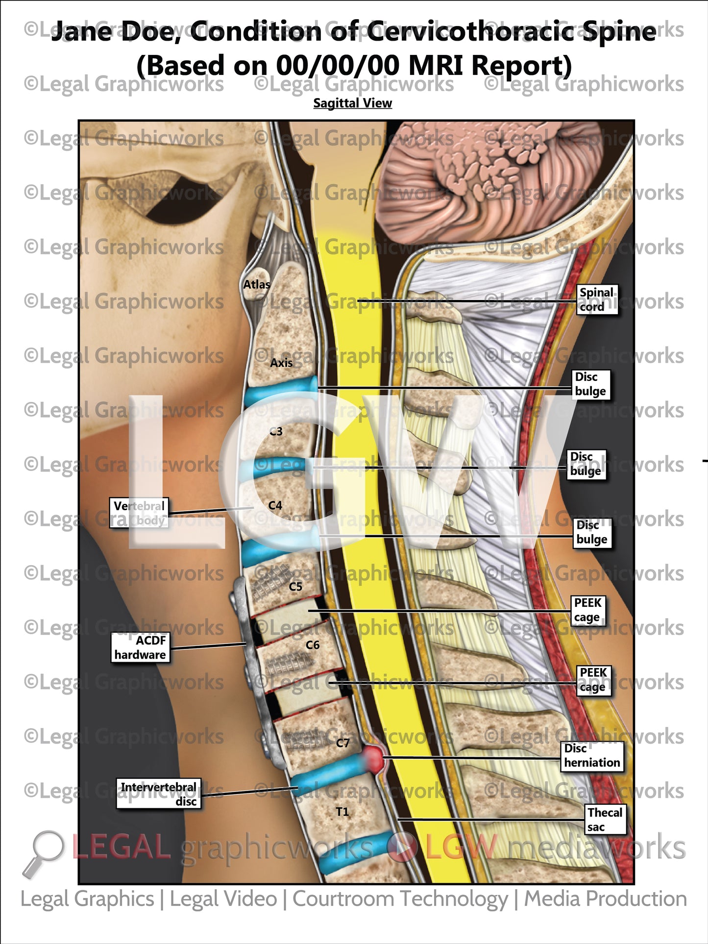 Condition of Cervicothoracic Spine