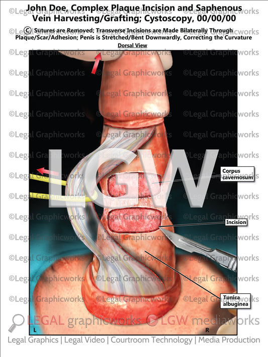Complex Plaque Incision and Saphenous Vein Harvesting/Grafting; Cystoscopy
