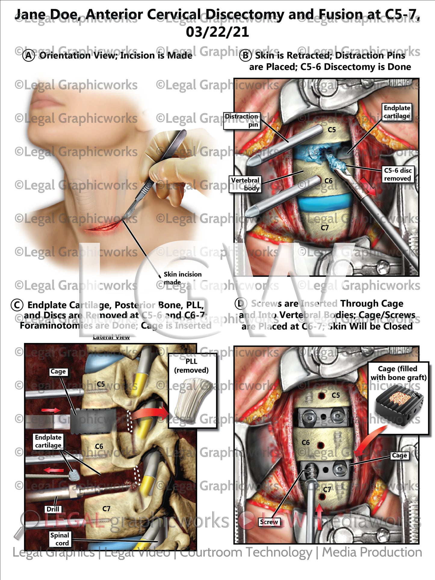 Anterior Cervical Discectomy and Fusion at C5-7