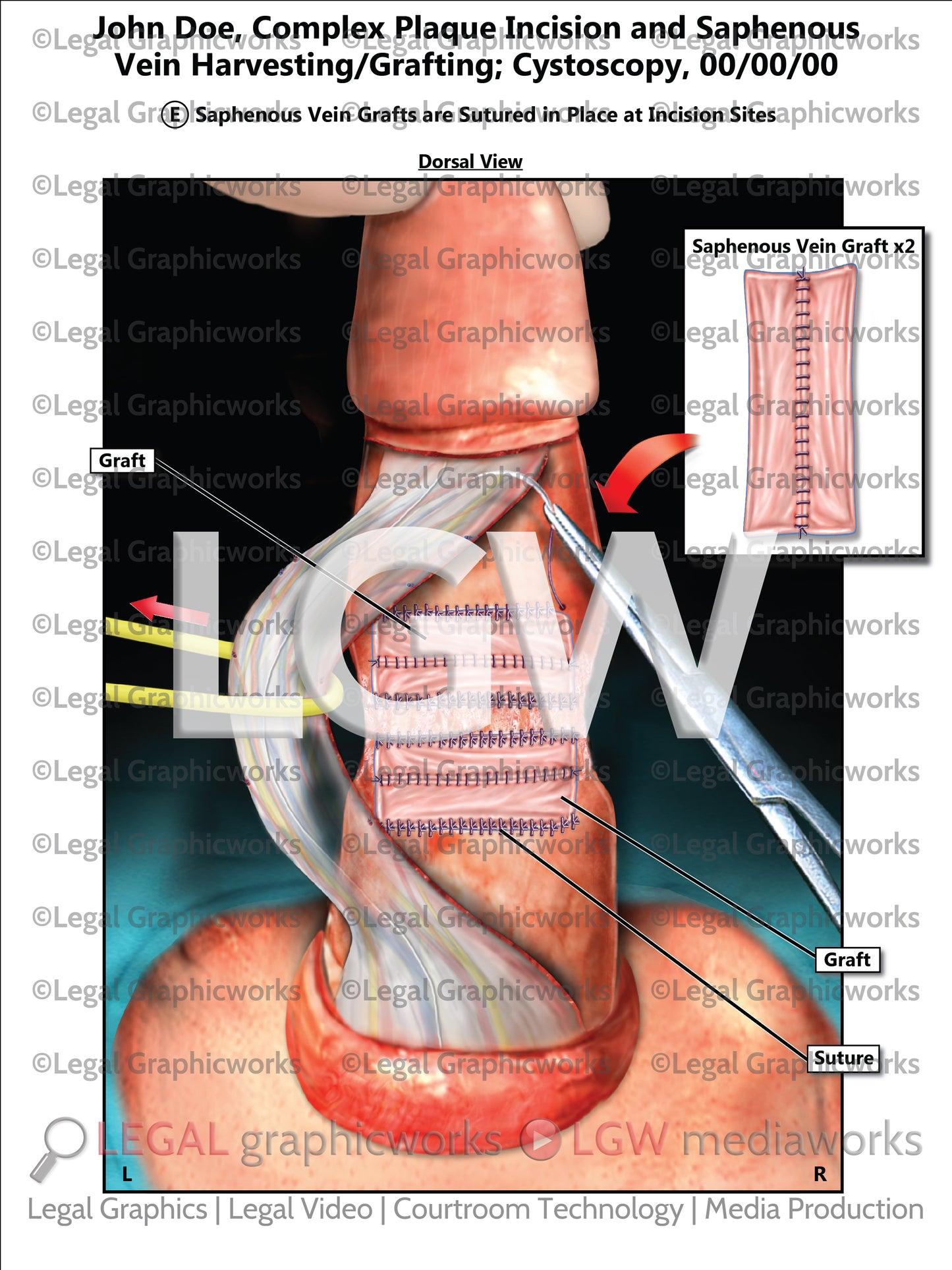 Complex Plaque Incision and Saphenous Vein Harvesting/Grafting; Cystoscopy