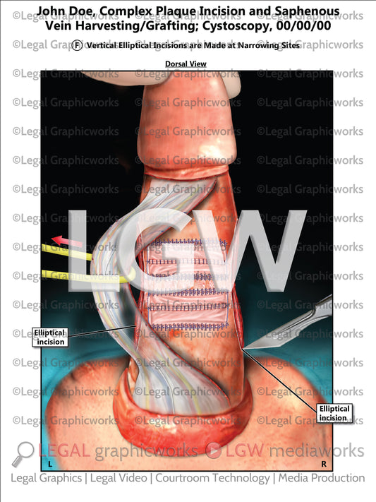 Complex Plaque Incision and Saphenous Vein Harvesting/Grafting; Cystoscopy