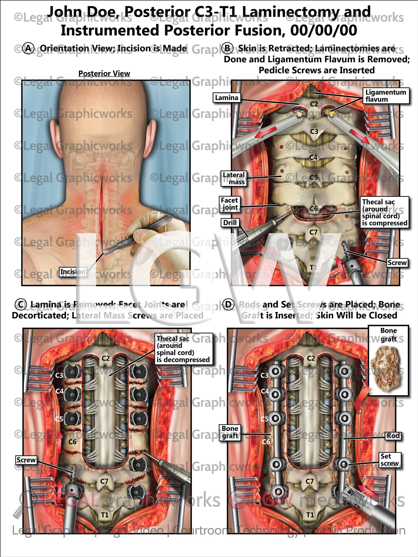 Posterior C3-T1 Laminectomy and Instrumented Posterior Fusion
