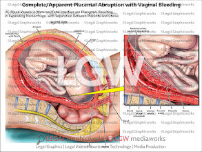 Complete/Apparent Placental Abruption with Vaginal Bleeding