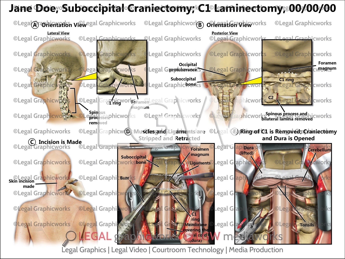 Suboccipital Craniectomy; C1 Laminectomy