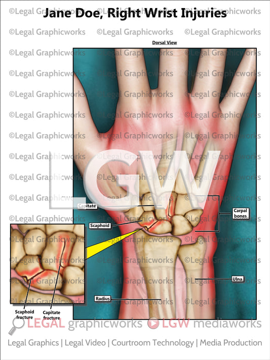 Right Wrist Injuries
