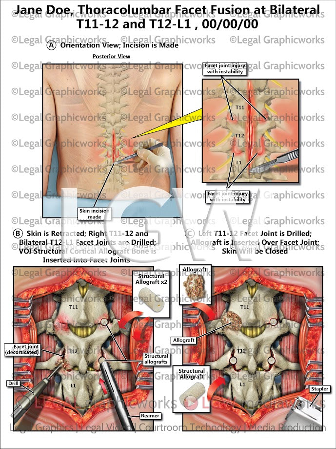 Thoracolumbar Facet Fusion at Bilateral T11-12 and T12-L1