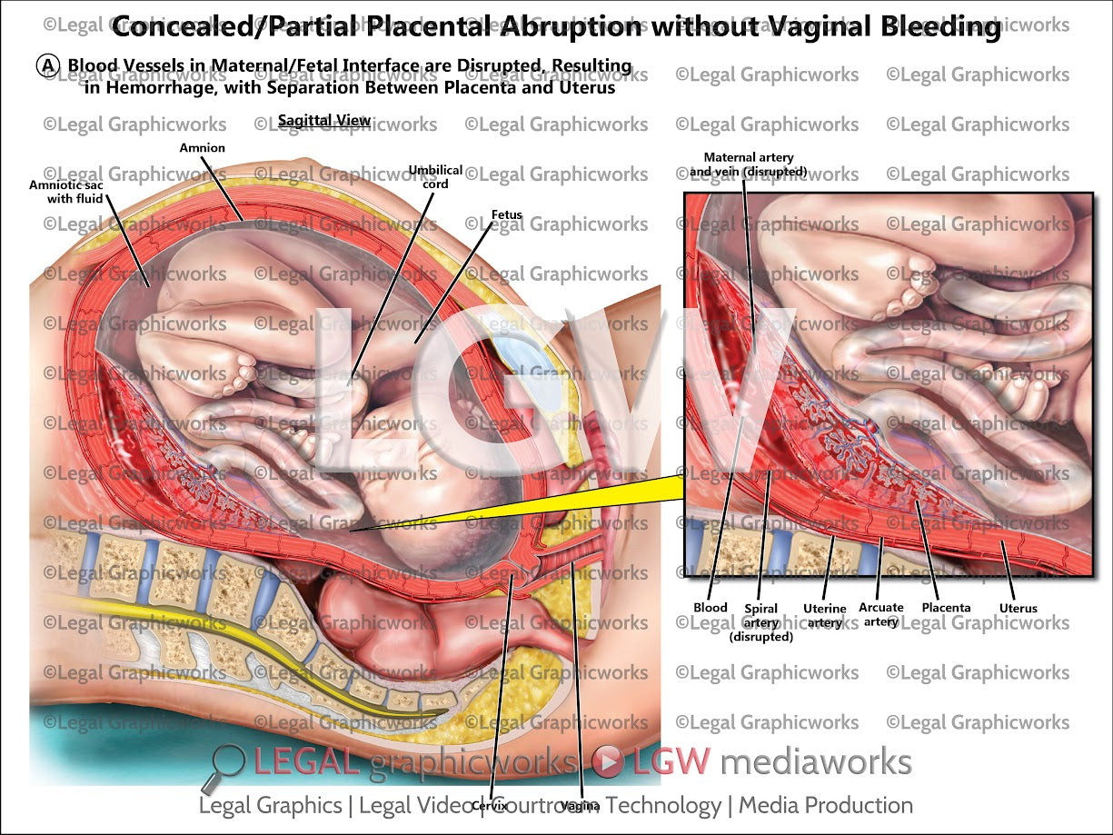 Concealed/Partial Placental Abruption without Vaginal Bleeding