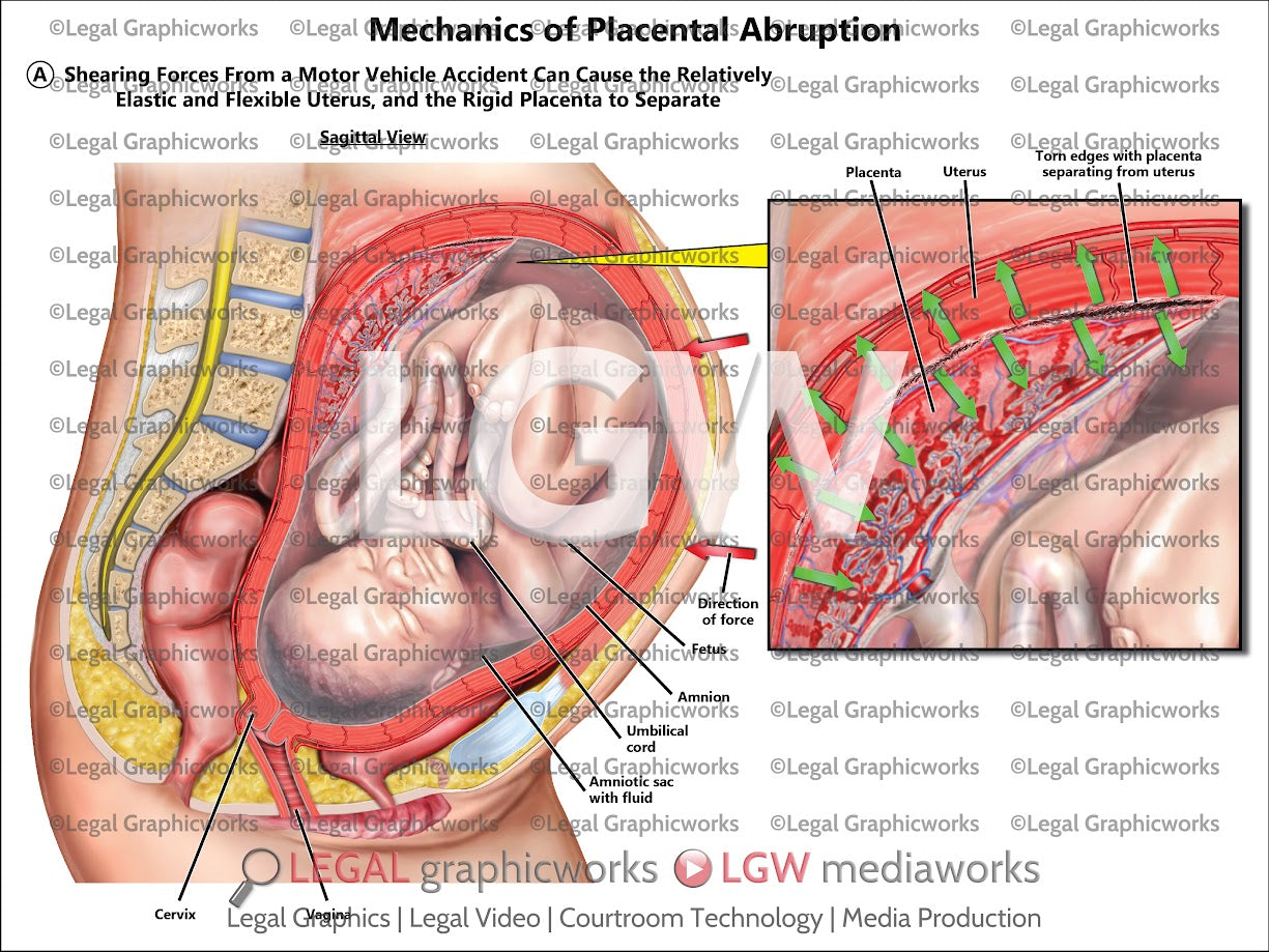 Mechanics of Placental Abruption