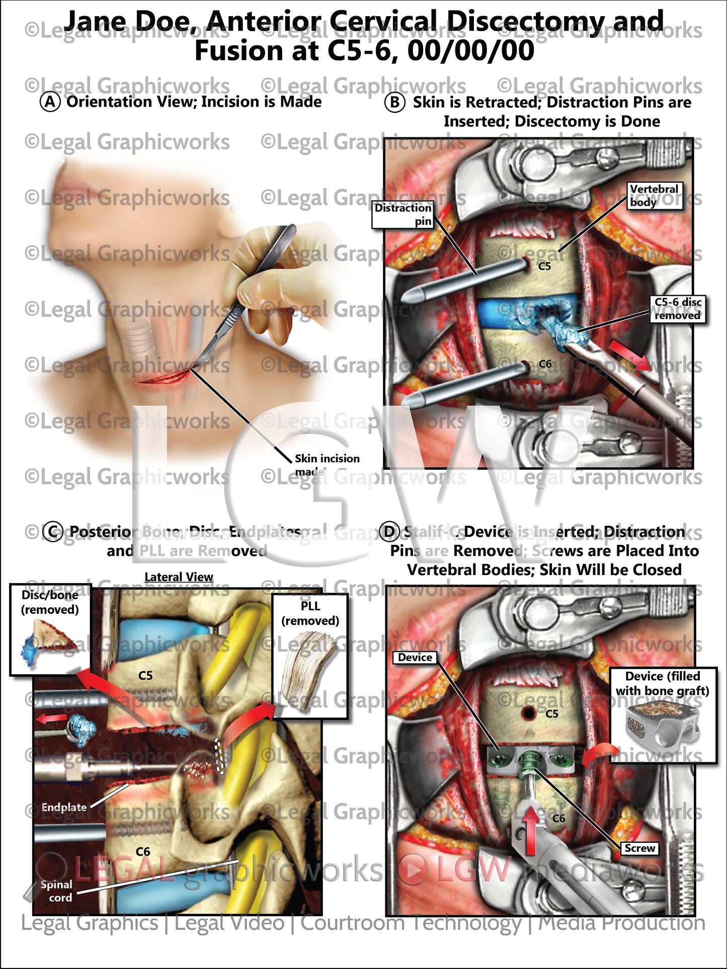 Anterior Cervical Discectomy and Fusion at C5-6