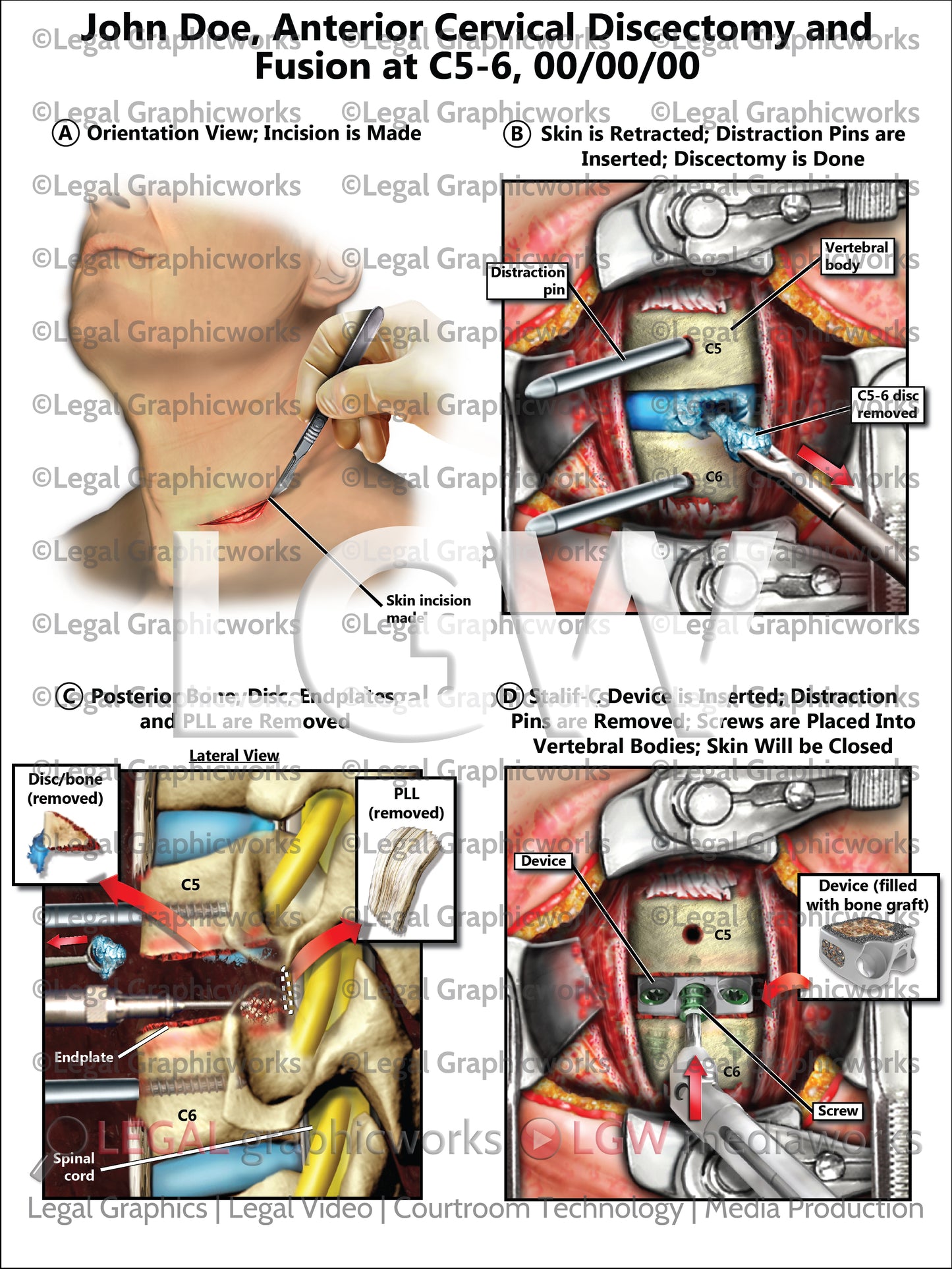 Anterior Cervical Discectomy and Fusion at C5-6