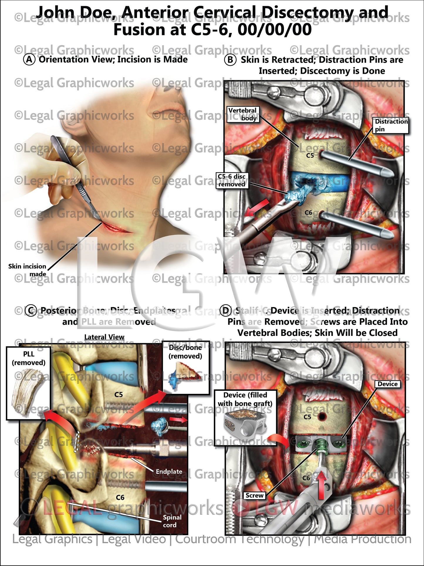 Anterior Cervical Discectomy and Fusion at C5-6