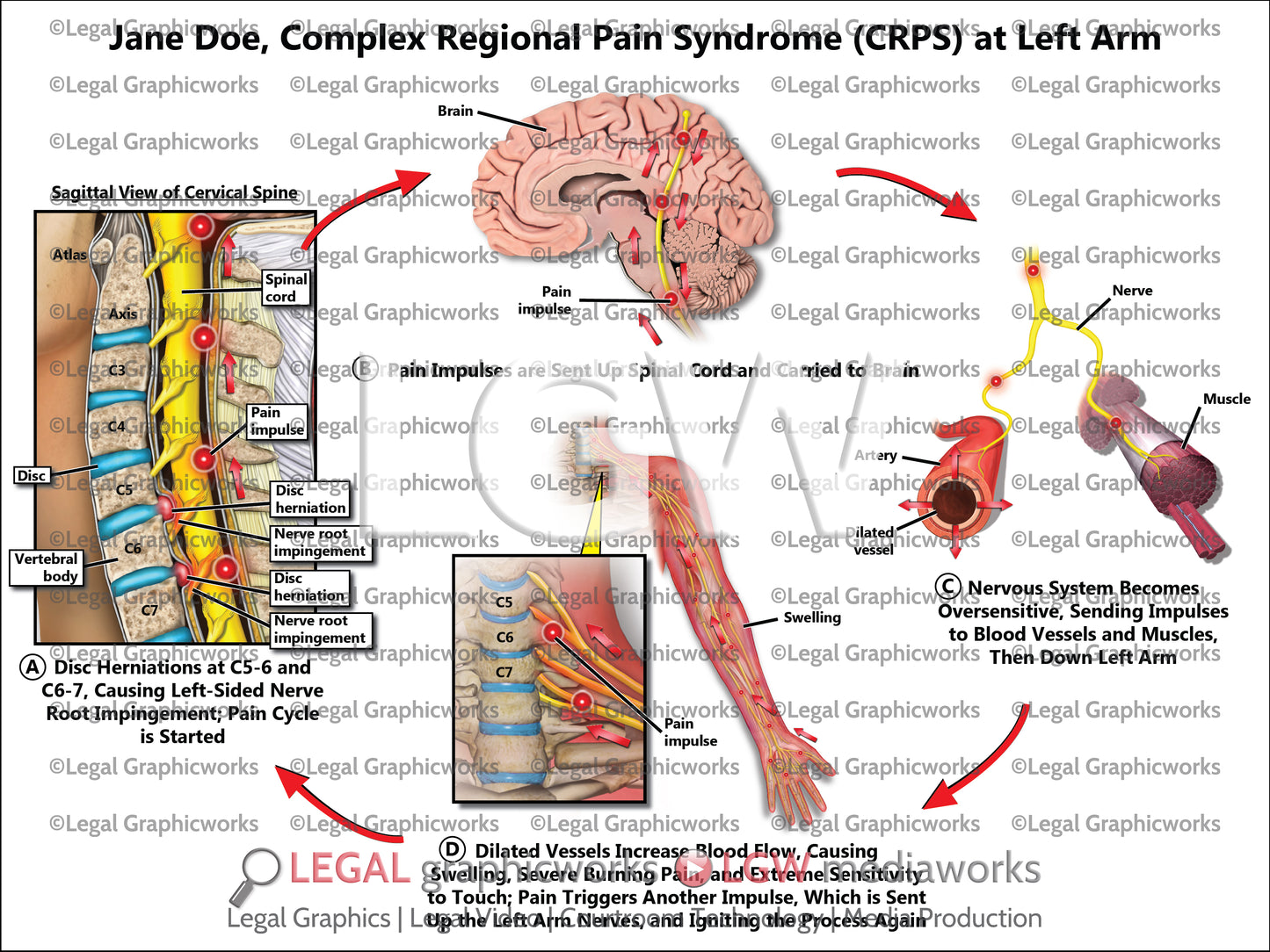 Complex Regional Pain Syndrome (CRPS) at Left Arm