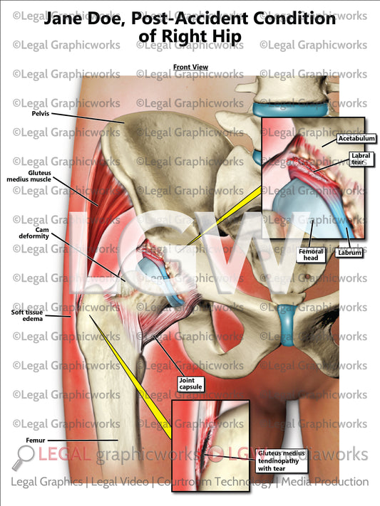 Post-Accident Condition of Right Hip