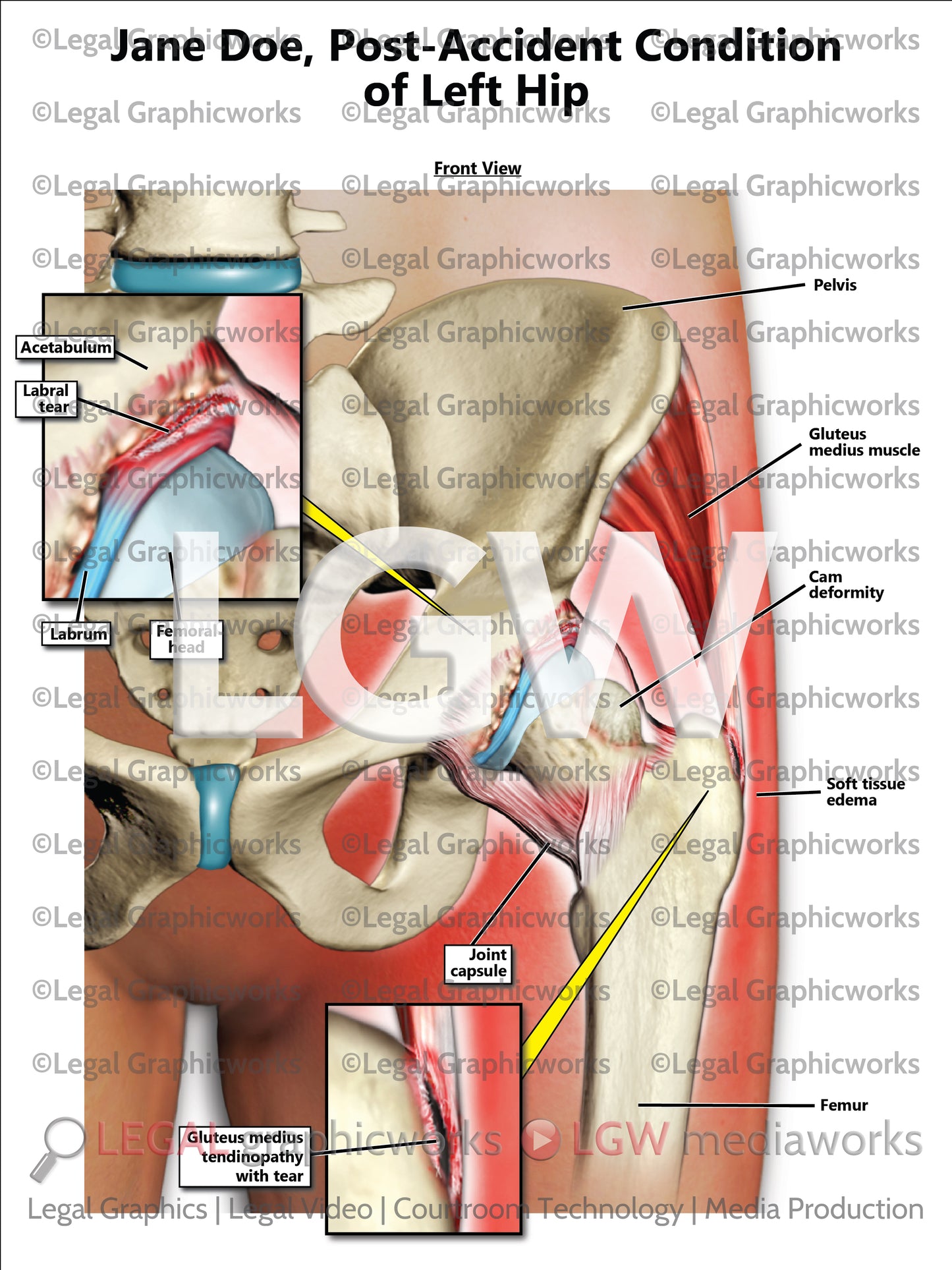 Post-Accident Condition of Left Hip