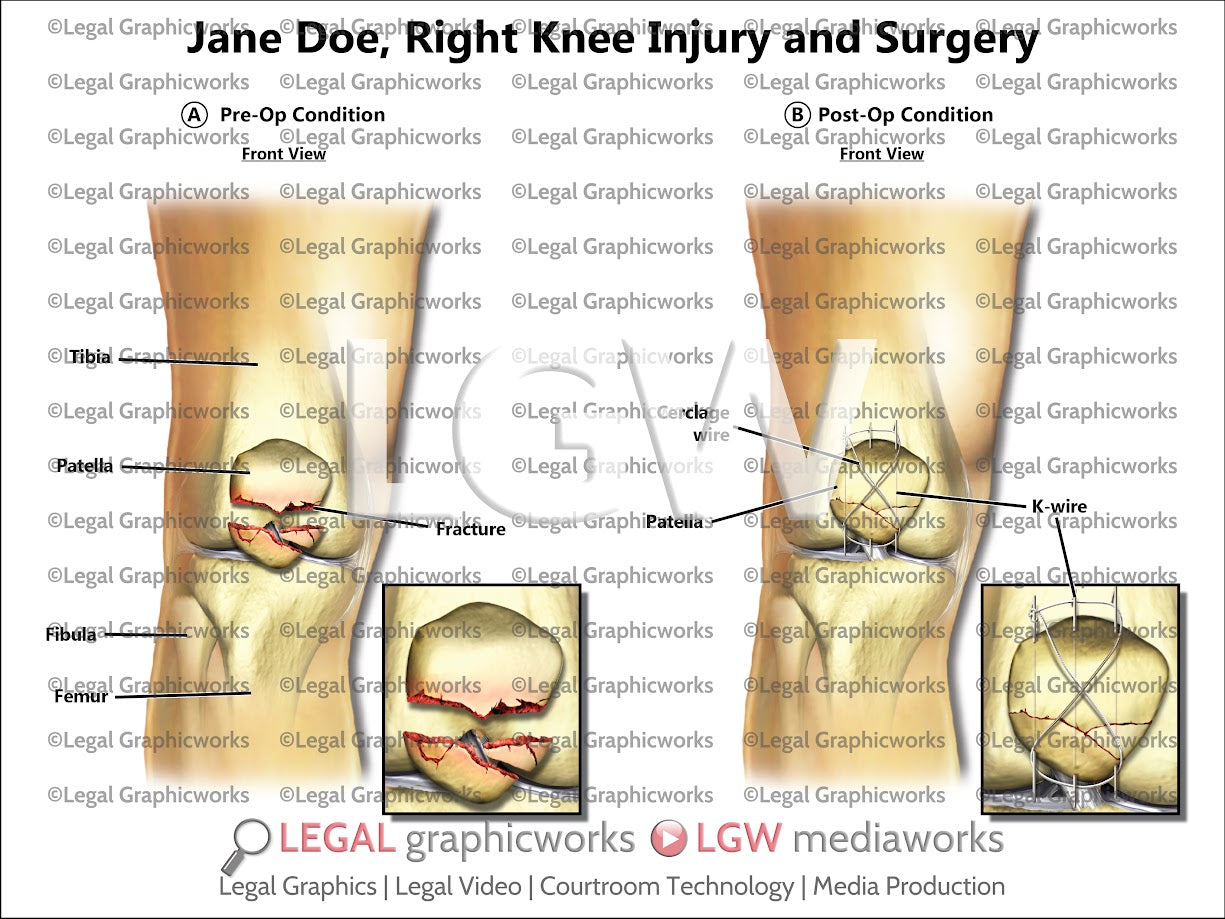 Right Knee Injury and Surgery