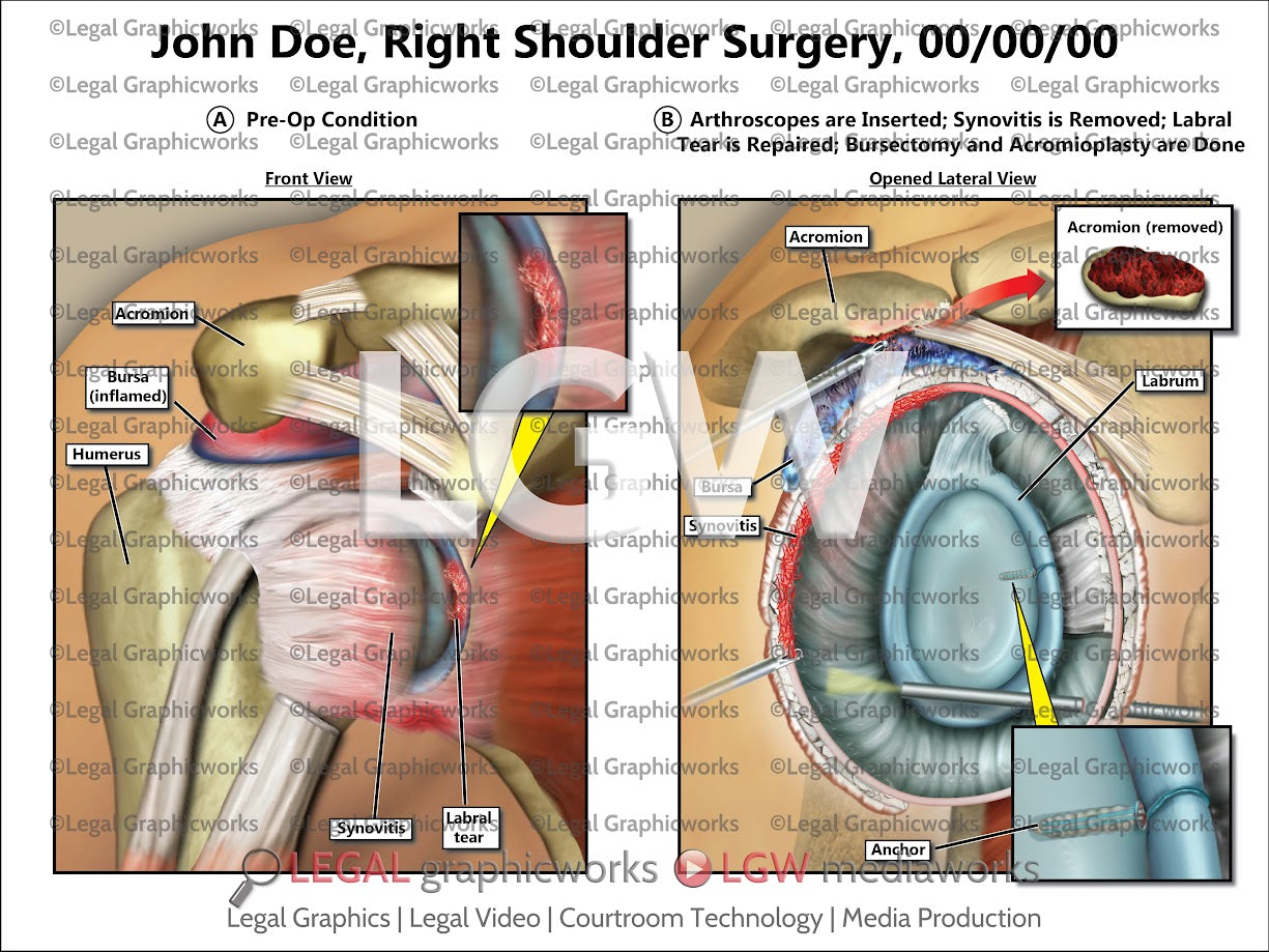 Right Shoulder Surgery