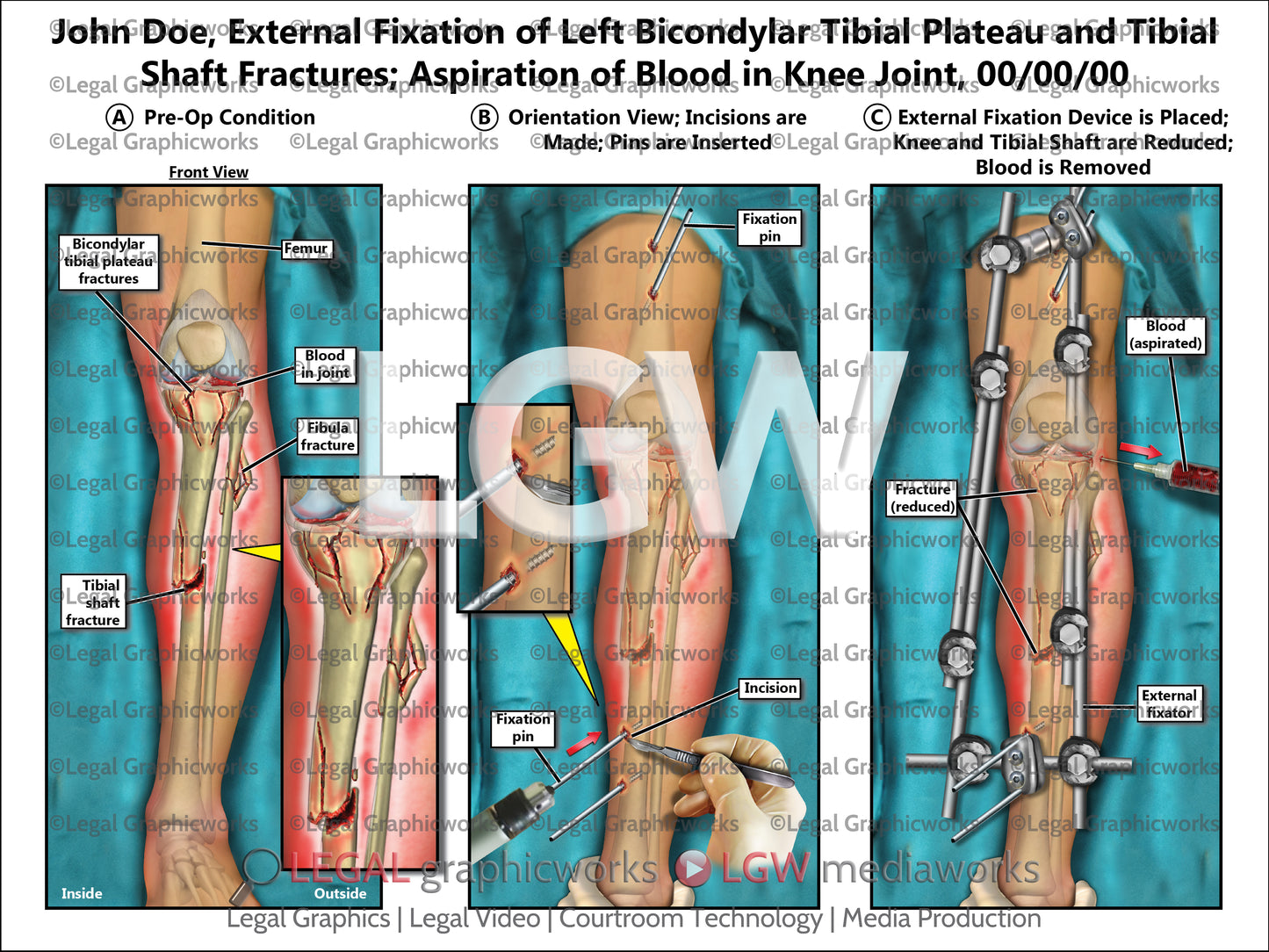 External Fixation of Left Bicondylar Tibial Plateau and Tibial Shaft Fractures; Aspiration of Blood in Knee Joint