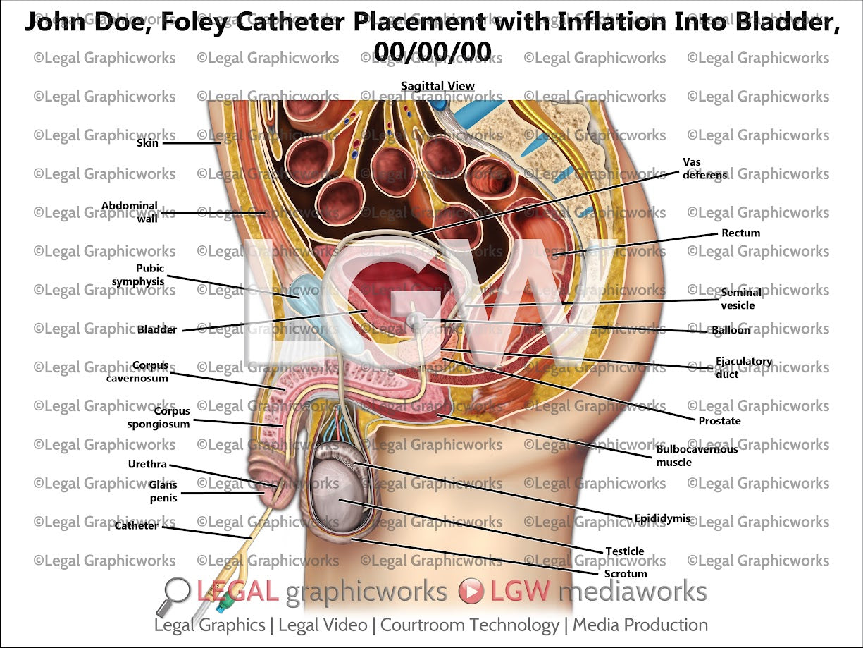Foley Catheter Placement with Inflation into Bladder
