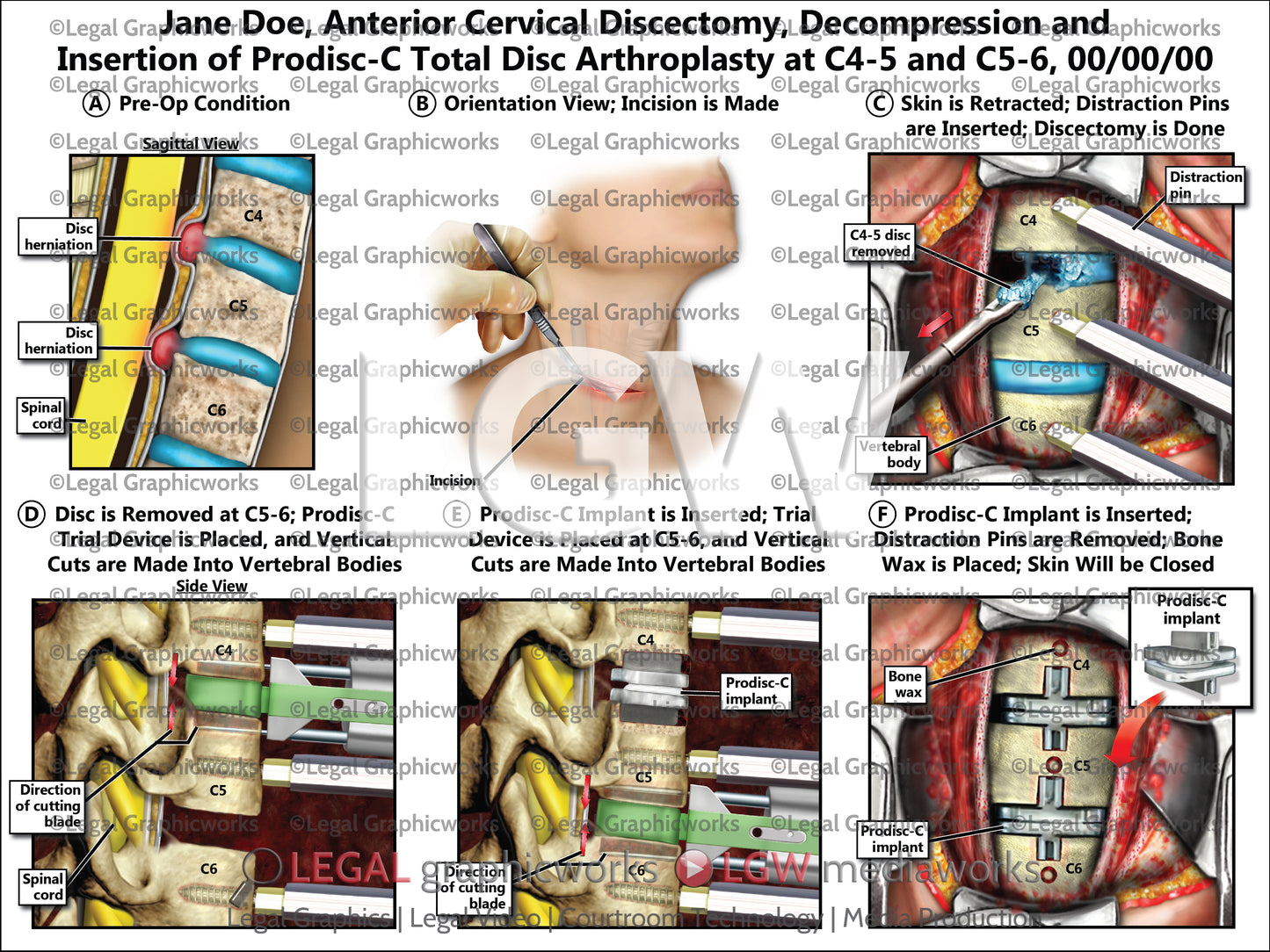 Anterior Cervical Discectomy, Decompression and Insertion of Prodisc-C Total Disc Arthroplasty at C4-5 and C5-6