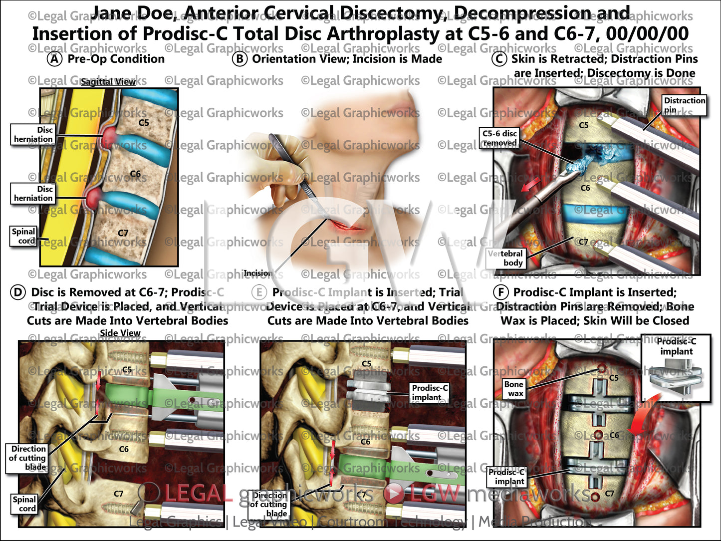 Anterior Cervical Discectomy, Decompression and Insertion of Prodisc-C Total Disc Arthroplasty at C5-6 and C6-7