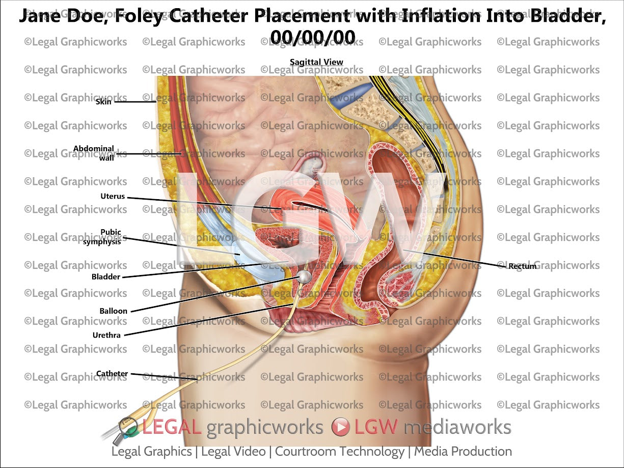 Foley Catheter Placement with Inflation into Bladder