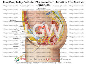 Foley Catheter Placement with Inflation into Bladder