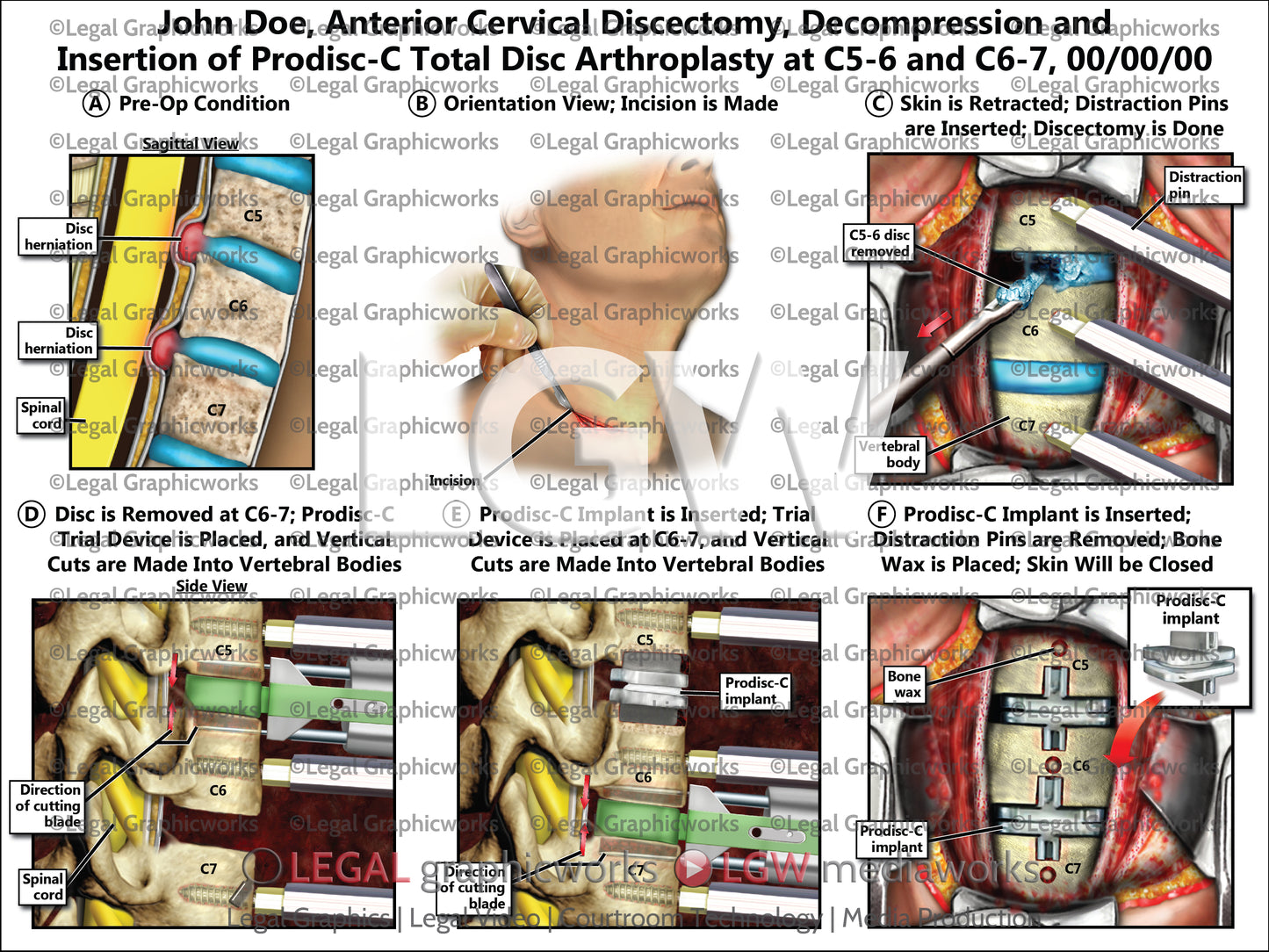 Anterior Cervical Discectomy, Decompression and Insertion of Prodisc-C Total Disc Arthroplasty at C5-6 and C6-7