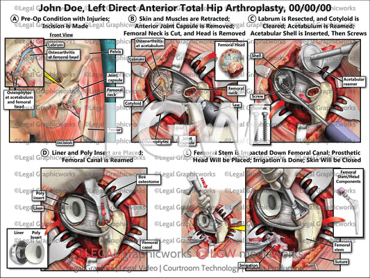 Left Direct Anterior Total Hip Arthroplasty