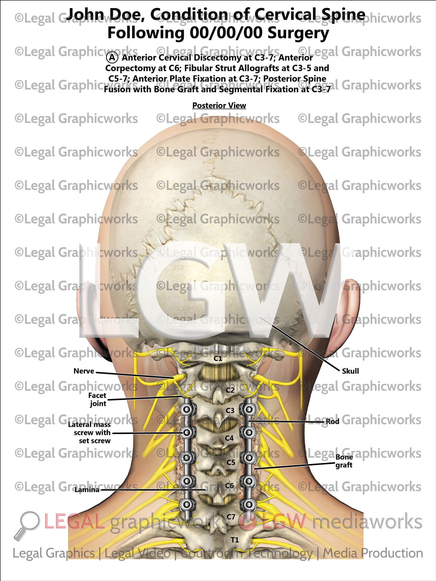 Condition of Cervical Spine Following Surgery