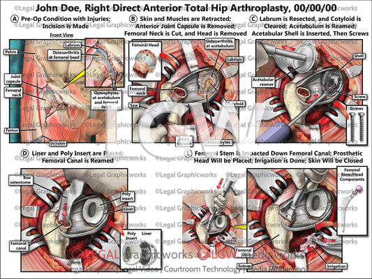 Right Direct Anterior Total Hip Arthroplasty