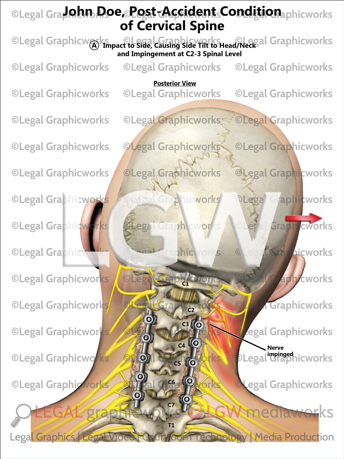 Post-Accident Condition of Cervical Spine