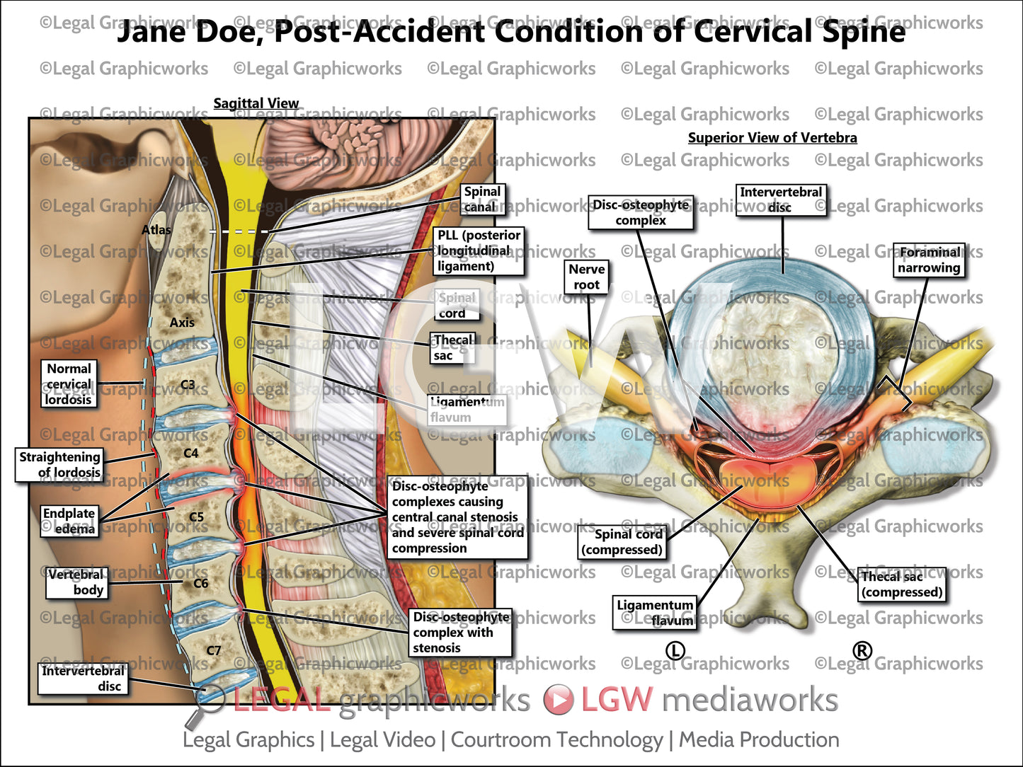 Post-Accident Condition of Cervical Spine