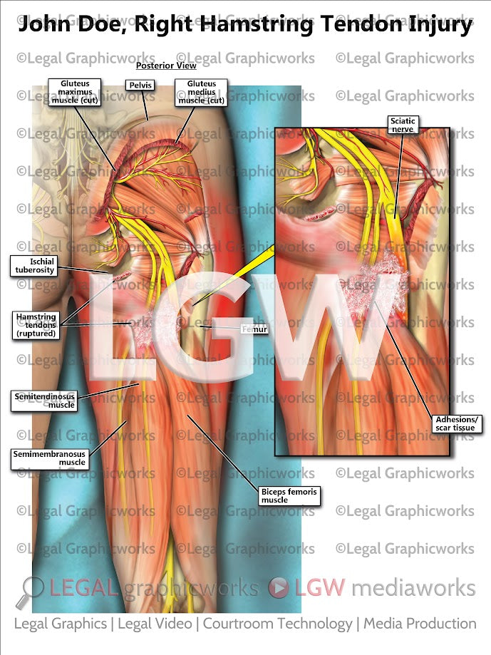 Right Hamstring Tendon Injury