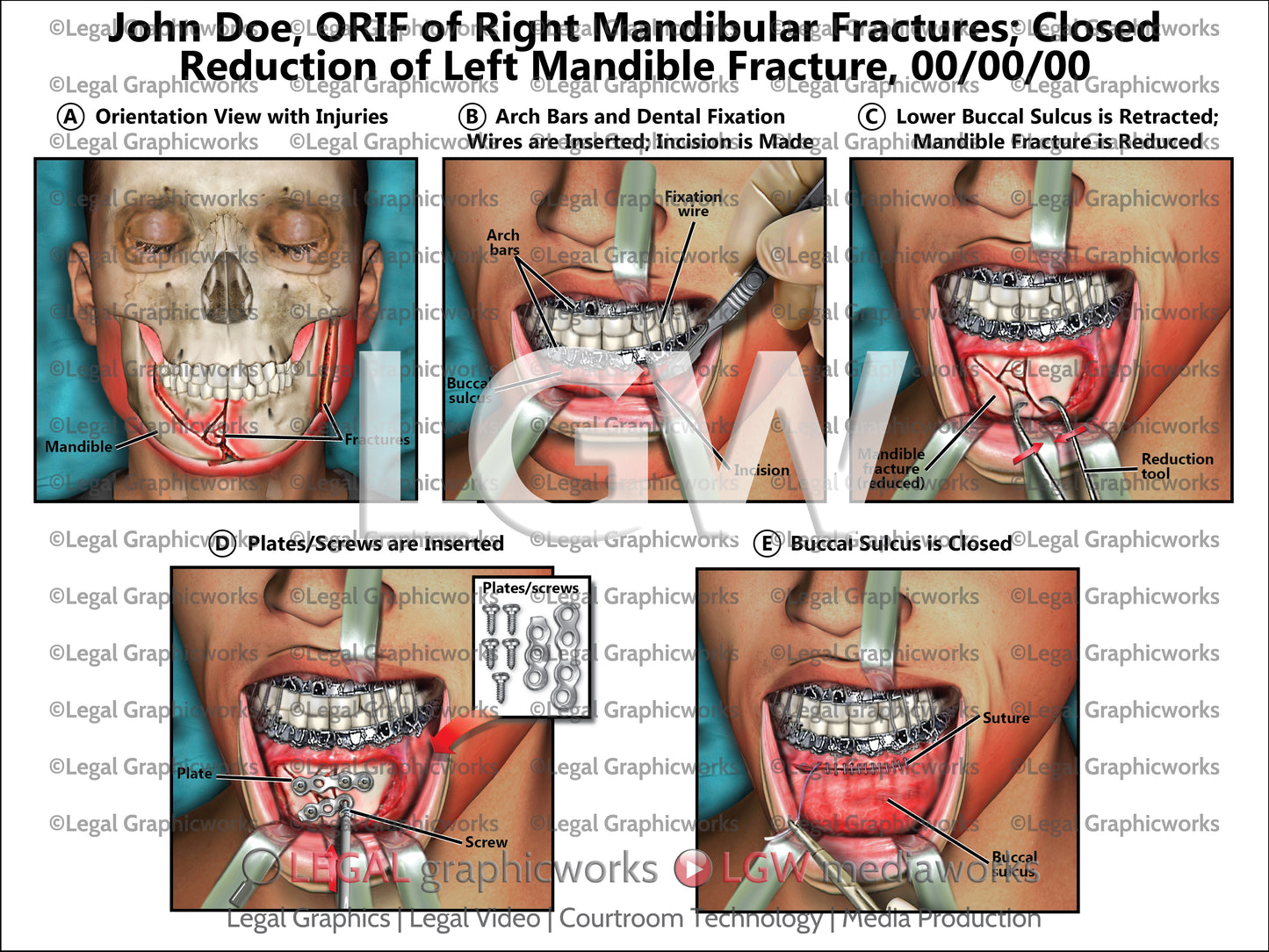 ORIF of Right Mandibular Fractures; Closed Reduction of Left Mandible Fracture