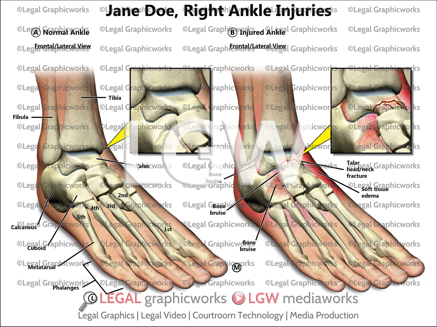 Right Ankle Injuries