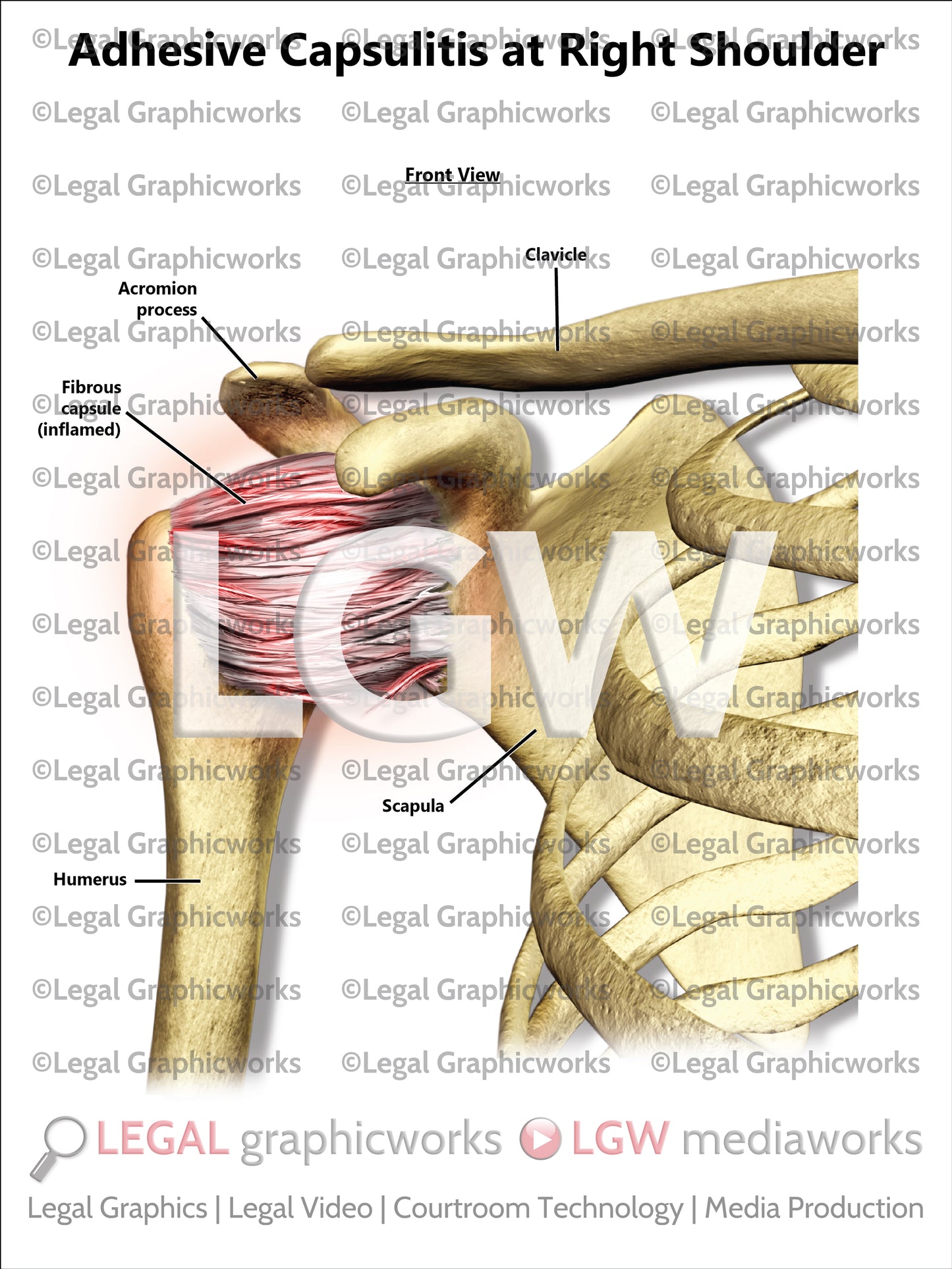 Adhesive Capsulitis at Right Shoulder