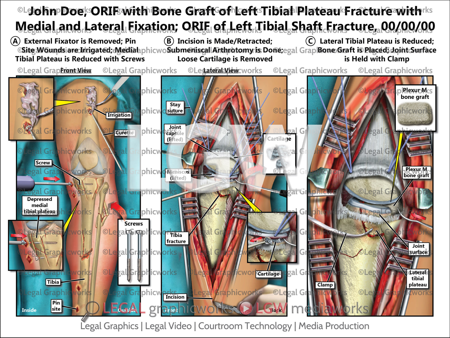ORIF with Bone Graft of Left Tibial Plateau Fracture with Medial and Lateral Fixation; ORIF of Left Tibial Shaft Fracture