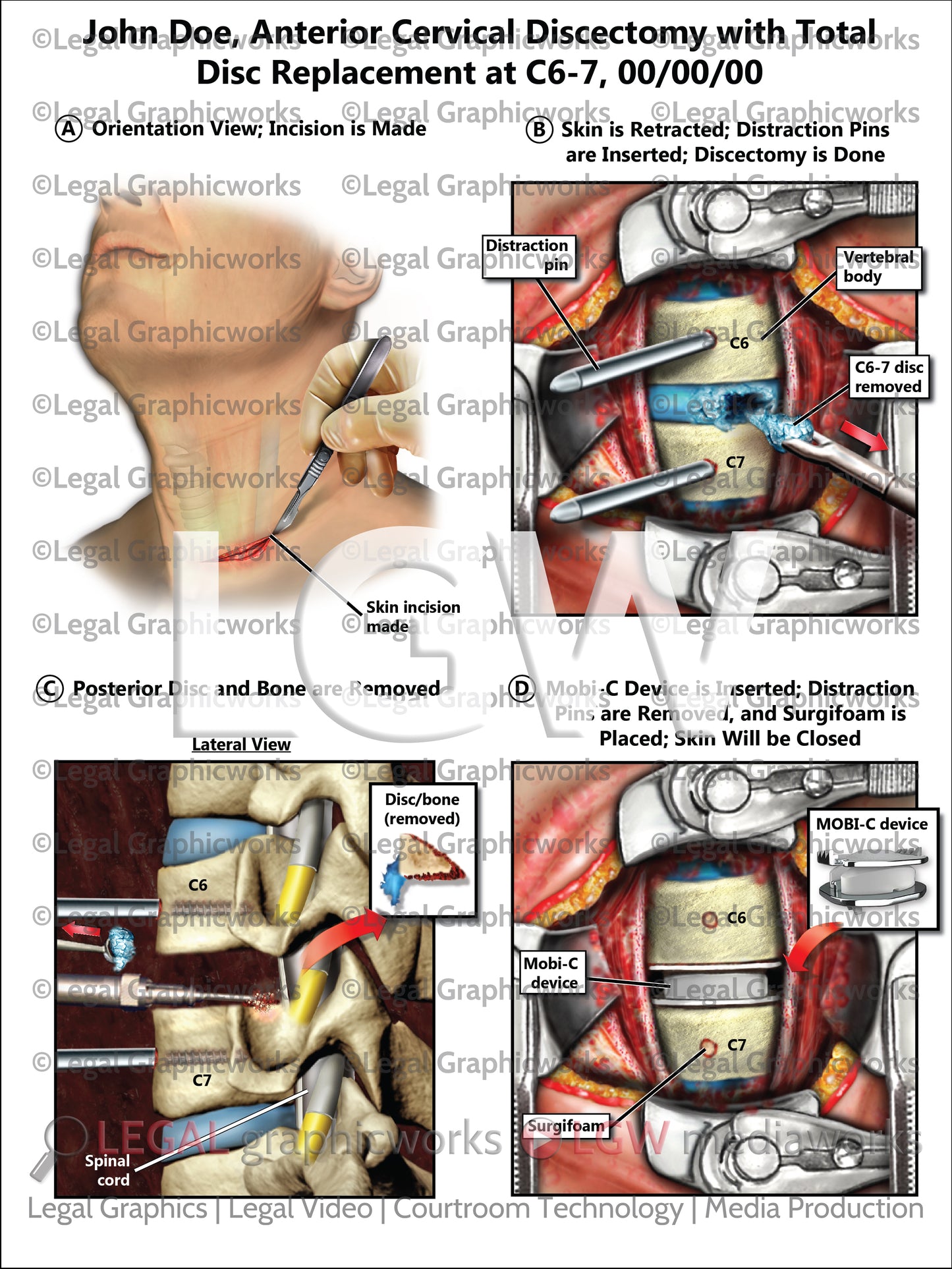Anterior Cervical Discectomy with Total Disc Replacement at C6-7