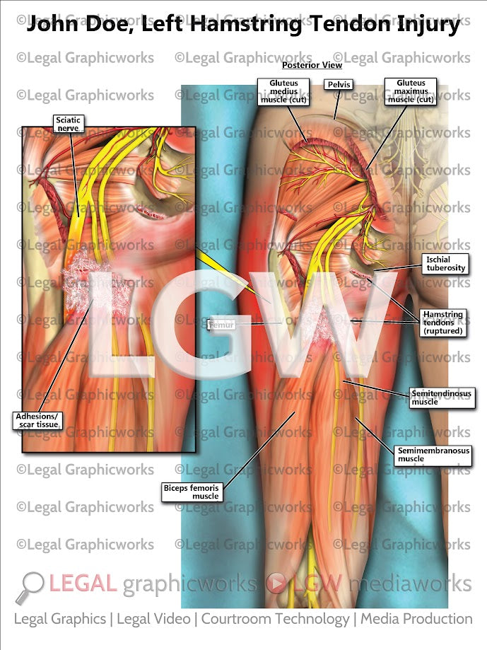 Left Hamstring Tendon Injury