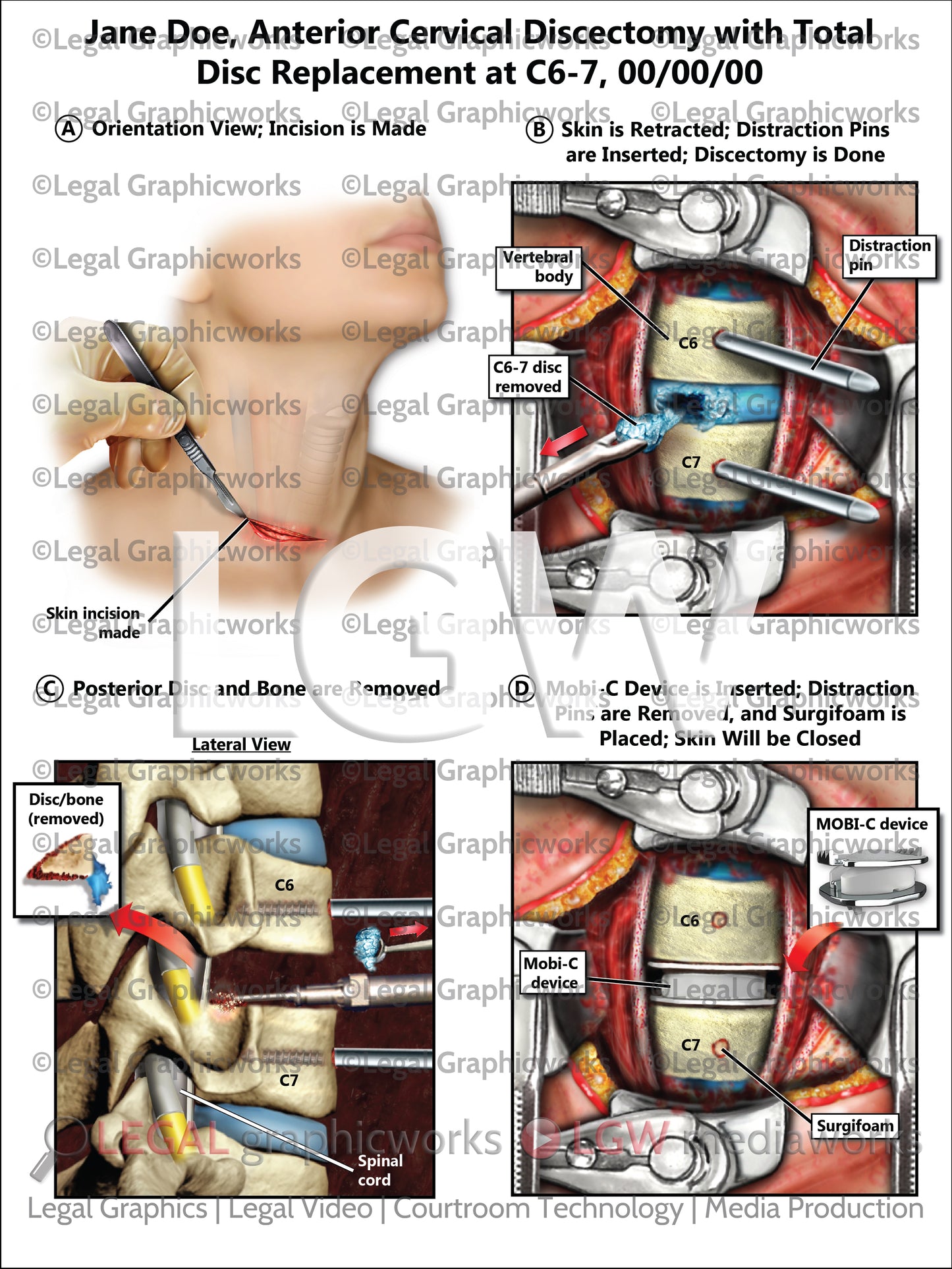 Anterior Cervical Discectomy with Total Disc Replacement at C6-7