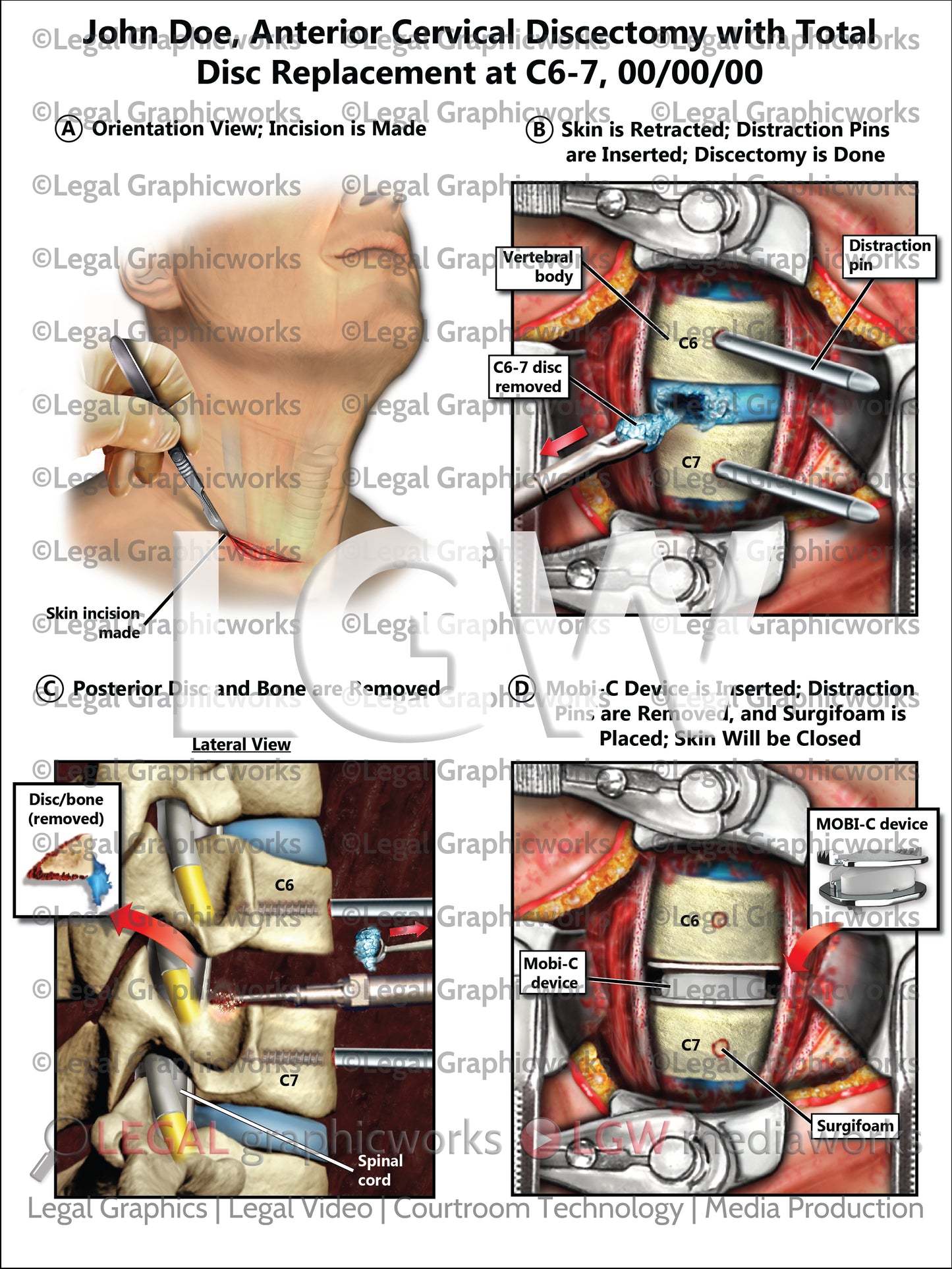 Anterior Cervical Discectomy with Total Disc Replacement at C6-7
