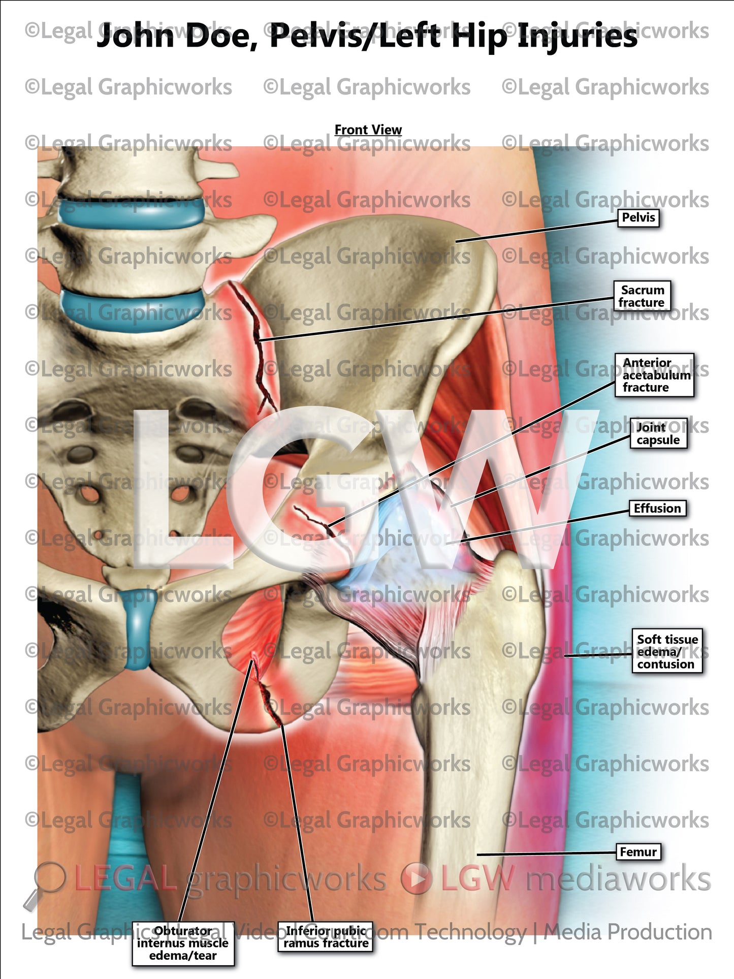 Pelvis/Left Hip Injuries