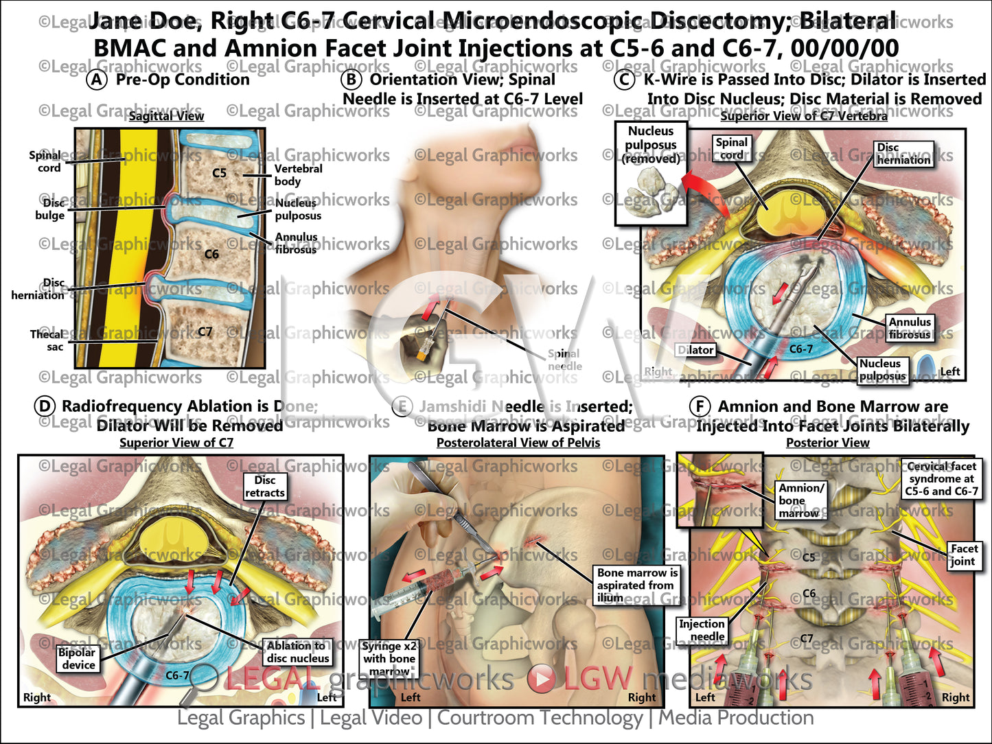 Right C6-7 Cervical Microendoscopic Discectomy; Bilateral BMAC and Amnion Facet Joint Injections at C5-6 and C6-7